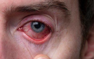 Atasi Mata Kemerahan Akibat Penggunaan Softlens