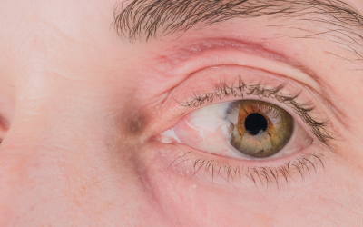 Mengenal Pterigium, “Sayap Daging” pada Mata yang Sering Dianggap Sepele